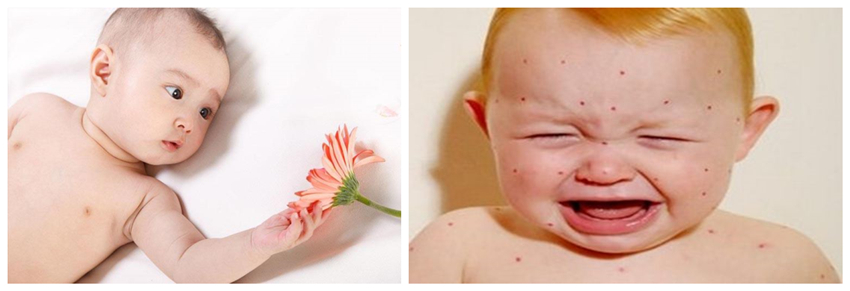 儿童湿疹反反复复,您有在家安装家用除湿产品吗?